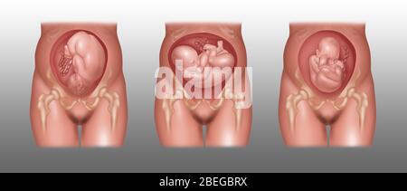 Posizioni del feto in utero, illustrazione Foto Stock