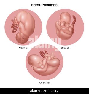 Posizioni del feto in utero, illustrazione Foto Stock