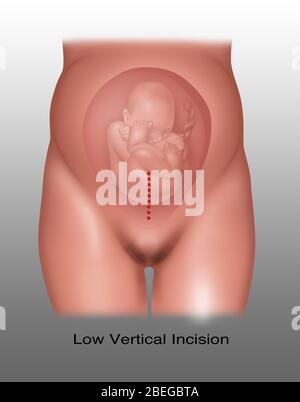 Incisione cesareo verticale bassa, illustrazione Foto Stock