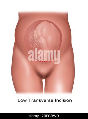 Illustrazione di una bassa incisione cesarea trasversale utilizzata per somministrare un feto posizionato normalmente. Foto Stock