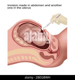 Fasi della sezione Cesarana, illustrazione, 1 di 4 Foto Stock