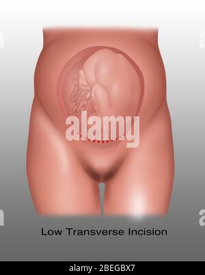 Incisione Cesareo trasversale bassa, illustrazione Foto Stock