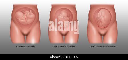 Tipi di incisione Cesarean, illustrazione Foto Stock