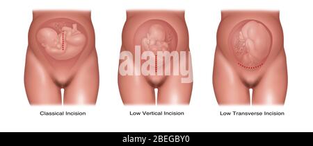 Tipi di incisione Cesarean, illustrazione Foto Stock