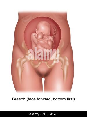 Feto in posizione Breech, illustrazione Foto Stock