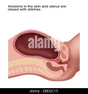 Fasi della sezione Cesarana, illustrazione, 4 di 4 Foto Stock