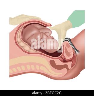 Fasi della sezione Cesarana, illustrazione, 2 di 4 Foto Stock