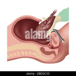 Fasi della sezione Cesarana, illustrazione, 3 di 4 Foto Stock