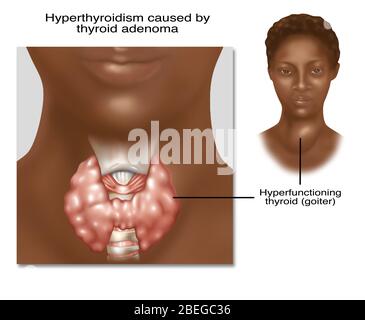 Ipertiroidismo, illustrazione Foto Stock