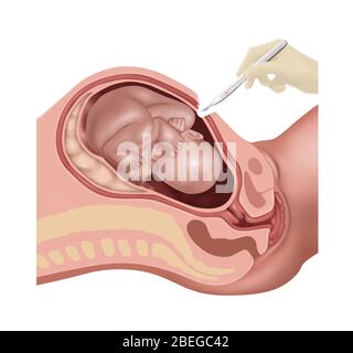 Fasi della sezione Cesarana, illustrazione, 1 di 4 Foto Stock