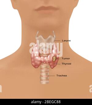 Cancro della tiroide, illustrazione Foto Stock