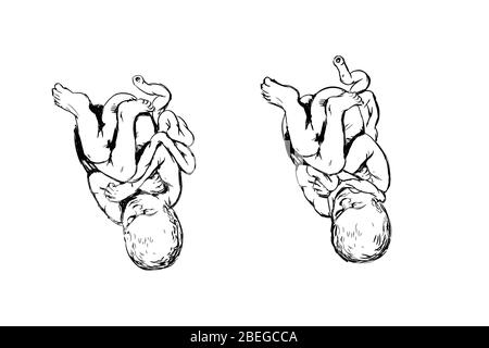 Illustrazione che mostra un bambino con il cavo nuchal (il cavo ombelicale avvolto intorno al collo), una condizione che può potenzialmente causare complicazioni alla nascita, come asfissia. Foto Stock