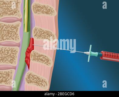 Procedura epidurale del cerotto ematico, illustrazione Foto Stock