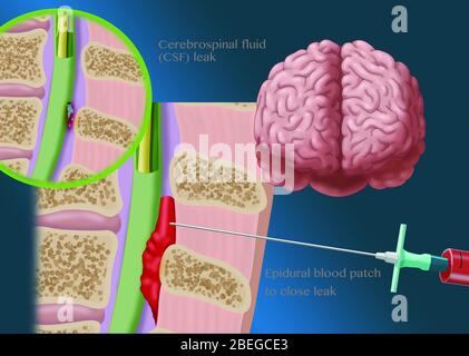 Procedura epidurale del cerotto ematico, illustrazione Foto Stock