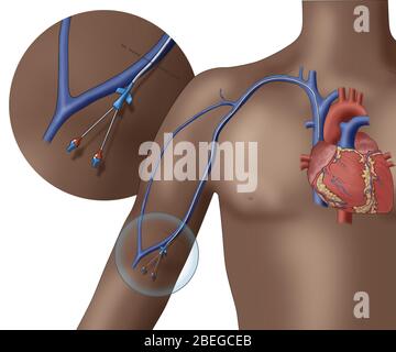 PICC dispositivo endovenoso, illustrazione Foto Stock