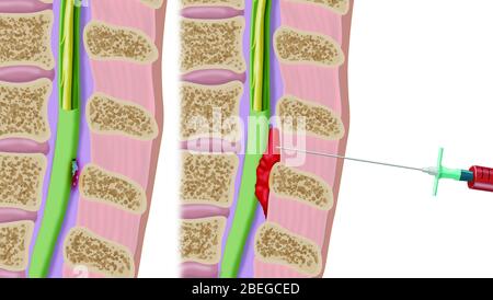 Procedura epidurale del cerotto ematico, illustrazione Foto Stock