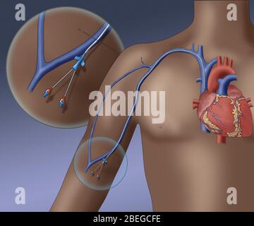 PICC dispositivo endovenoso, illustrazione Foto Stock