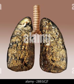 Polmoni di fumatore, illustrazione Foto Stock