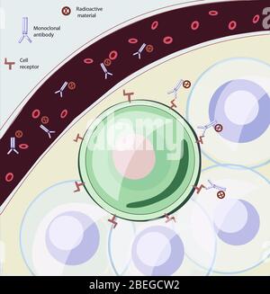 Illustrazione che mostra come la radioimmunoterapia (RIT) agisce per uccidere i tumori nel corpo. RIT utilizza anticorpi monoclonali ingegnerizzati accoppiati con materiale radioattivo. Questi vengono iniettati nel flusso sanguigno dove si legano alle cellule tumorali per erogare radiazioni direttamente al tumore. Foto Stock