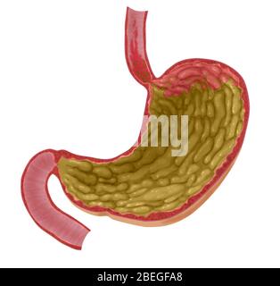 Illustrazione di riflusso acido Foto Stock