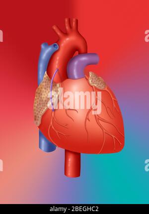 Trapianto di vena coronarica Foto Stock