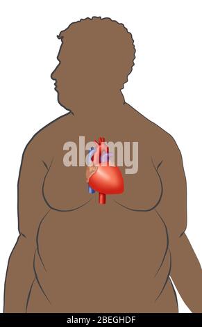 L'obesità aumenta il rischio di malattie cardiache Foto Stock