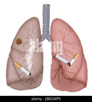 Polmoni sani e cancerosi Foto Stock