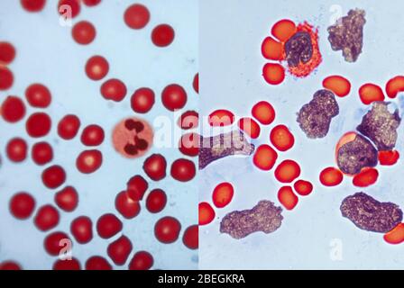 Confronto sangue sano/leucemia Foto Stock