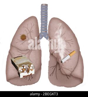 Cancro del polmone Foto Stock