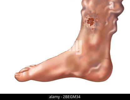 Ulcera cutanea da vena varicosa sulla caviglia Foto Stock