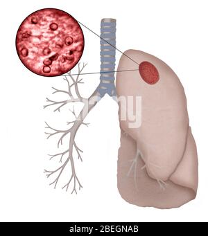 Pneumocystis Jirovecii Foto Stock