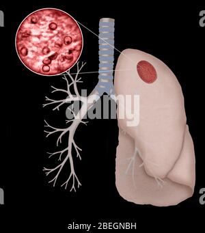 Pneumocystis Jirovecii Foto Stock