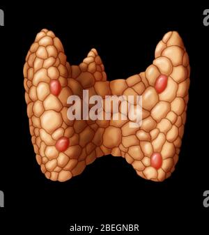 Paratiroide nella ghiandola tiroidea Foto Stock