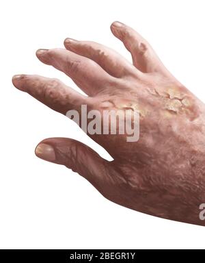 Il keratosis attinico Foto Stock