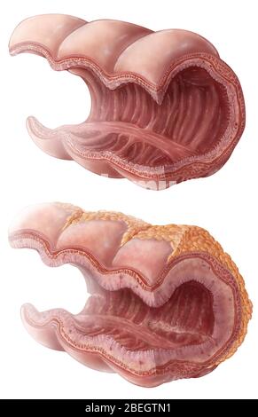 Progressione della malattia di Crohn Foto Stock