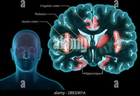 Risposta cerebrale maschile al dolore Foto Stock