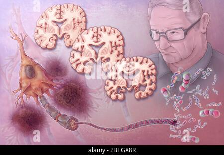 Patologia del morbo di Alzheimer Foto Stock
