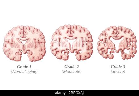 Progressione del morbo di Alzheimer Foto Stock