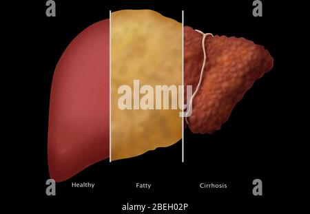 Fegato sano, grasso e cirrotico Foto Stock