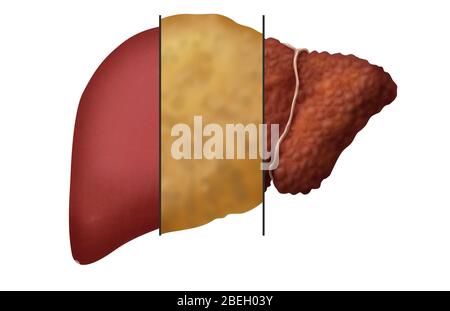 Fegato sano, grasso e cirrotico Foto Stock