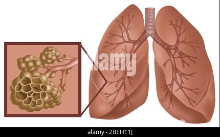 Polmoni e alveoli con enfisema Foto Stock