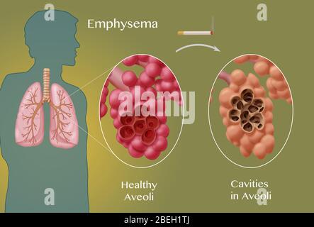 Confronto alveoli, enfisema Foto Stock