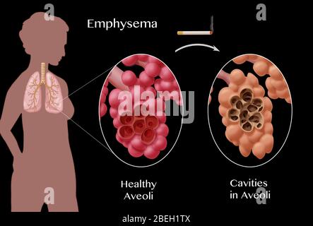 Confronto alveoli, enfisema Foto Stock