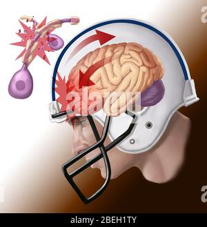 Illustrazione che mostra i danni dell'axon da una commozione, in cui la forza di rotazione del cervello può causare la torsione, la rottura o la rottura degli axon. I risultati di uno studio condotto su atleti morti della NFL che hanno sofferto di percussioni suggeriscono che il danno duraturo è fatto da lesioni assonali. Questo danno, la cui gravità aumenta con il numero cumulativo di percussioni sostenute, può portare ad una varietà di altri problemi di salute. Foto Stock