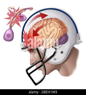 Lesioni assonali da commozione Foto Stock