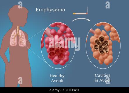 Confronto alveoli, enfisema Foto Stock