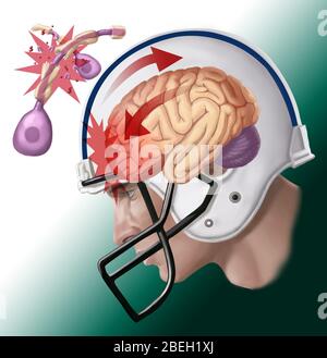 Lesioni assonali da commozione Foto Stock