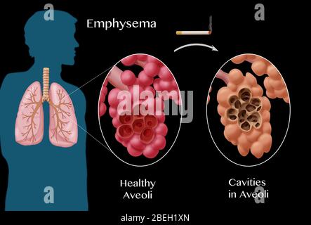 Confronto alveoli, enfisema Foto Stock