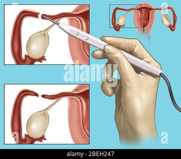 Cauterizzazione dei tubi di Falloppio Foto Stock