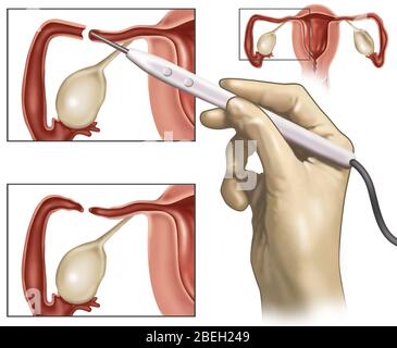 Cauterizzazione dei tubi di Falloppio Foto Stock